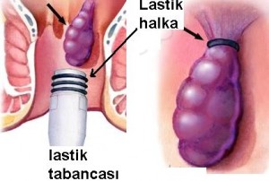 lastikle hemoroidi boğma ameliyatı