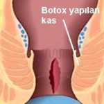 izmir anal makat çatlağı botox yapan yer