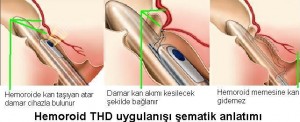 Hemoroid THD tedavisi