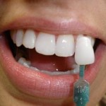 estetik diş uygulamaları adana