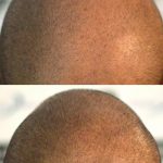 saç mikro pigmentasyonu