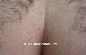 mikro-sinusektomi-video-izle