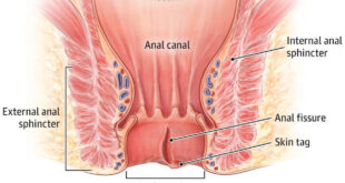 Anal fissür