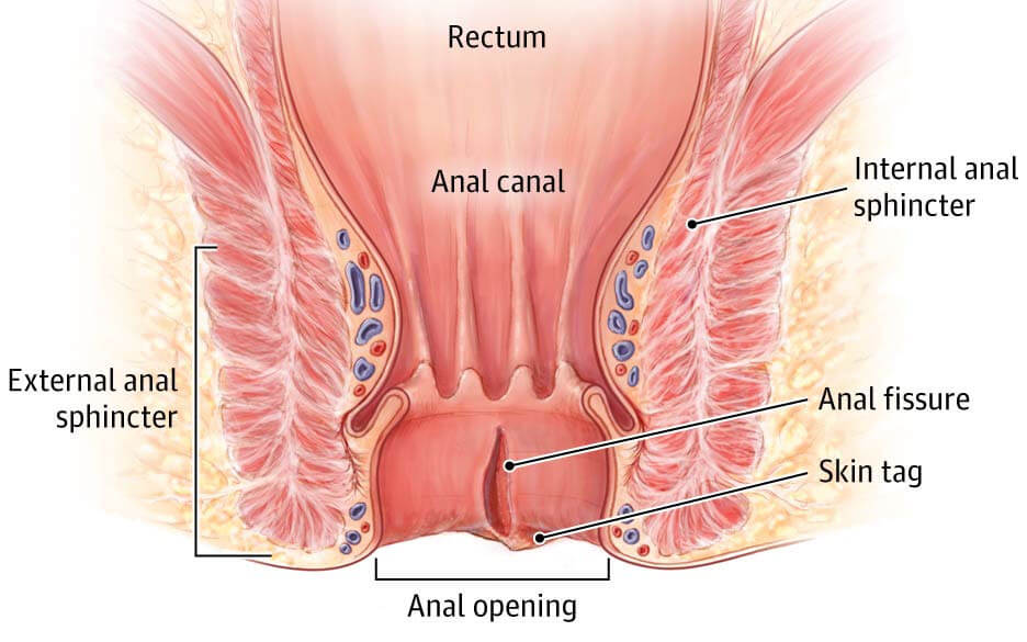 Anal Fissürün anatomik yapısı nasıl olduğu gösterilmekte